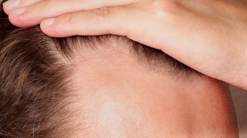 Exploring Oral Minoxidil: The Pill Form Of Rogaine For Hair