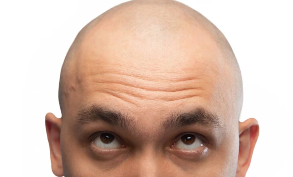 Natural Sugar Offers Hope For Hair Regrowth In Men Facing